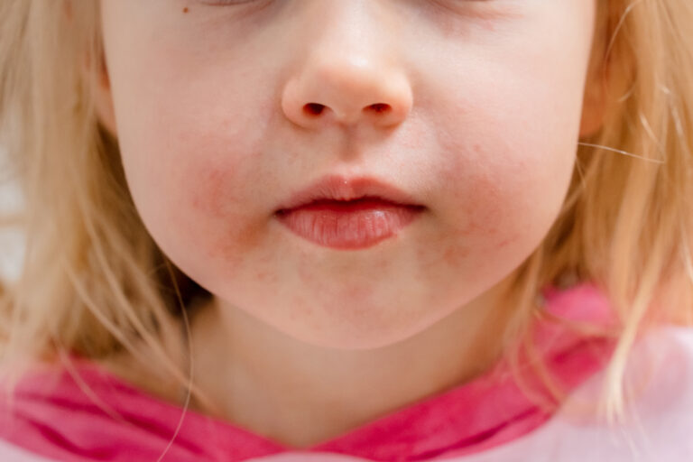 Dermatologie pediatrica la Wanderma Clinic grija medicala pentru pielea copiilor explicata pe intelesul parintilor